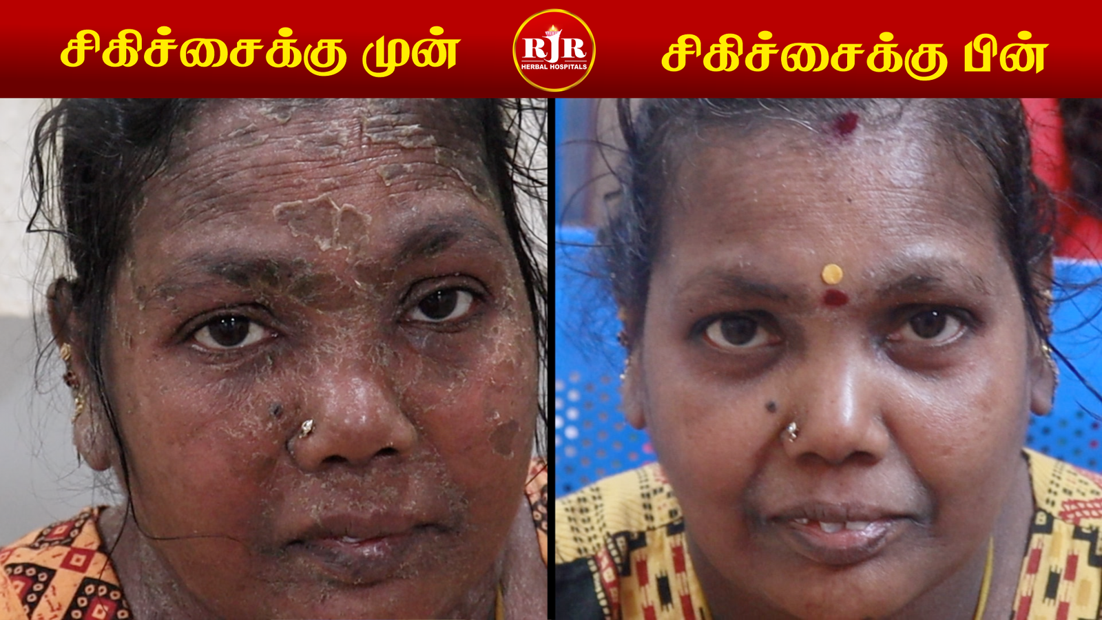 Before After
